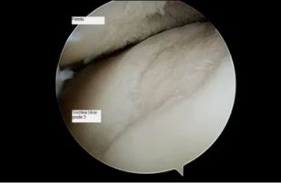 such astroscope is a knee joint osteoarthritis 3. degree