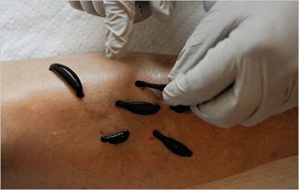 treatment of knee osteoarthritis with leech