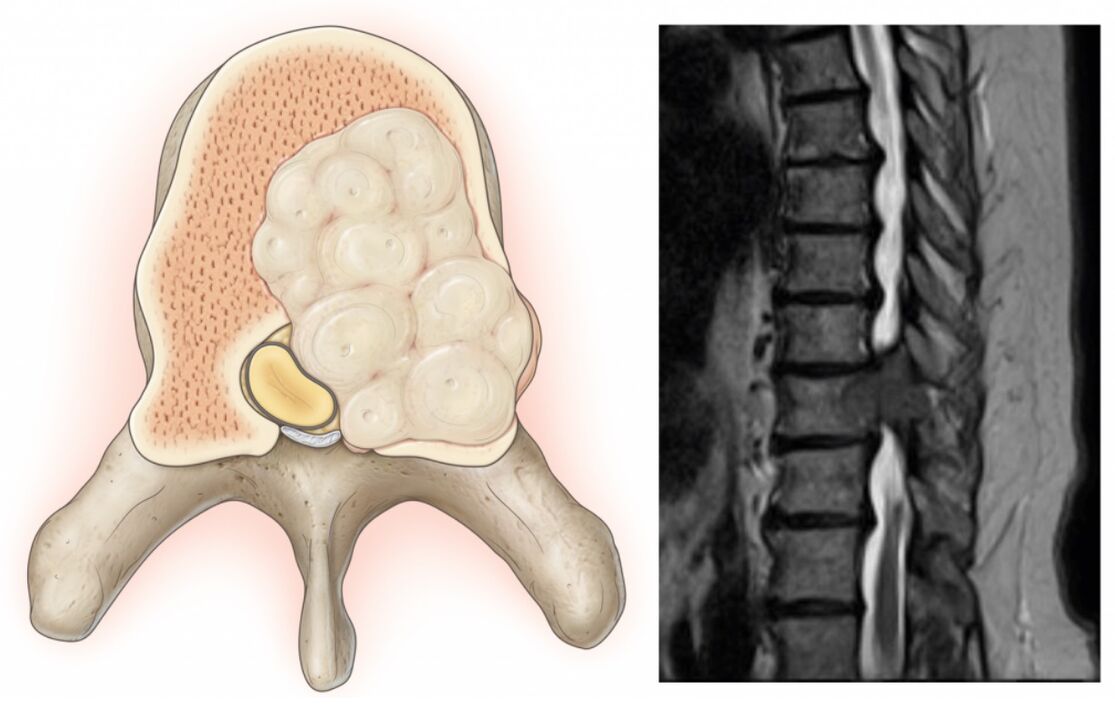 Swelling in the spine causes back pain