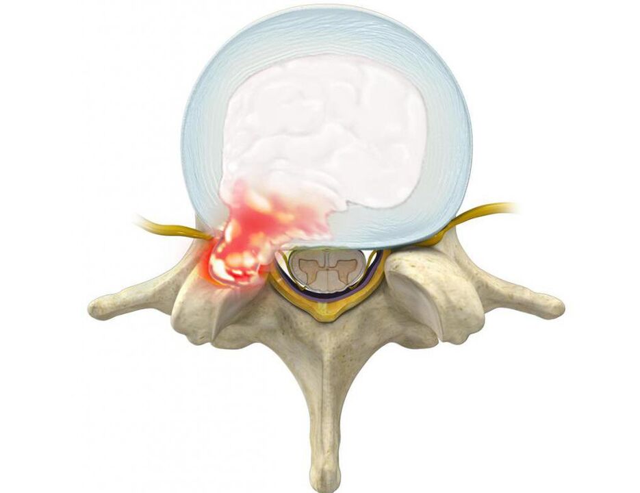 The damaged disc causes back pain