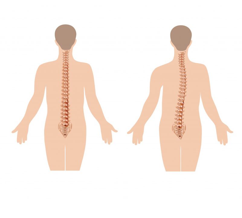 healthy and sick spine