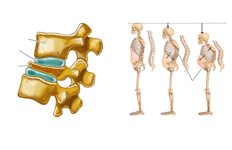 swaying spine causes back pain