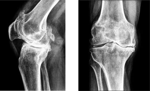 X-ray knee gonarthrosis