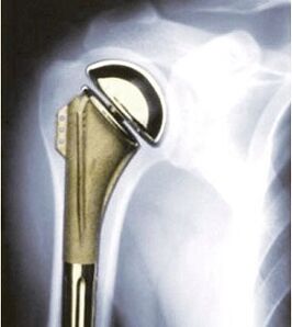 shoulder prostheses for osteoarthritis