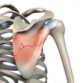 Scapular fracture is one of the causes of severe pain