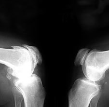 Osteoarthritis x-ray