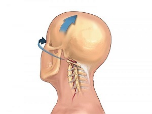 how cervical spine osteochondrosis manifests itself