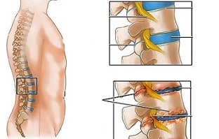 Causes of osteochondrosis of the lumbar spine