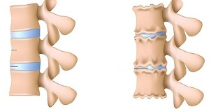 How to recognize the presence of lumbar osteochondrosis