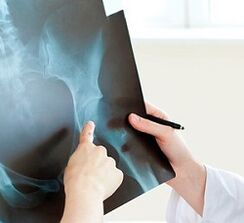 How to treat osteoarthritis of the hip joint