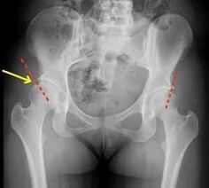 methods of treatment of osteoarthritis of the hip joint