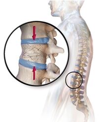 Osteoporosis causes back pain in the lower back