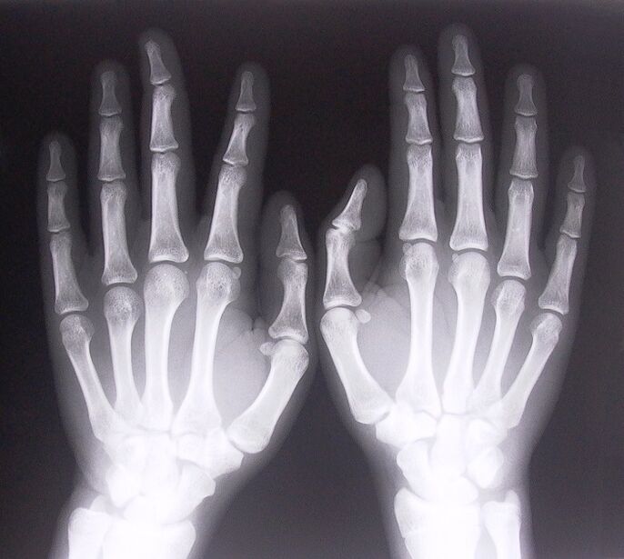 X-ray is a tool to determine the pain in the joints of the fingers